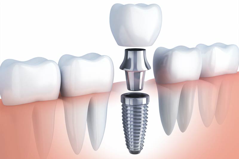 Implants Dentist in Fremont